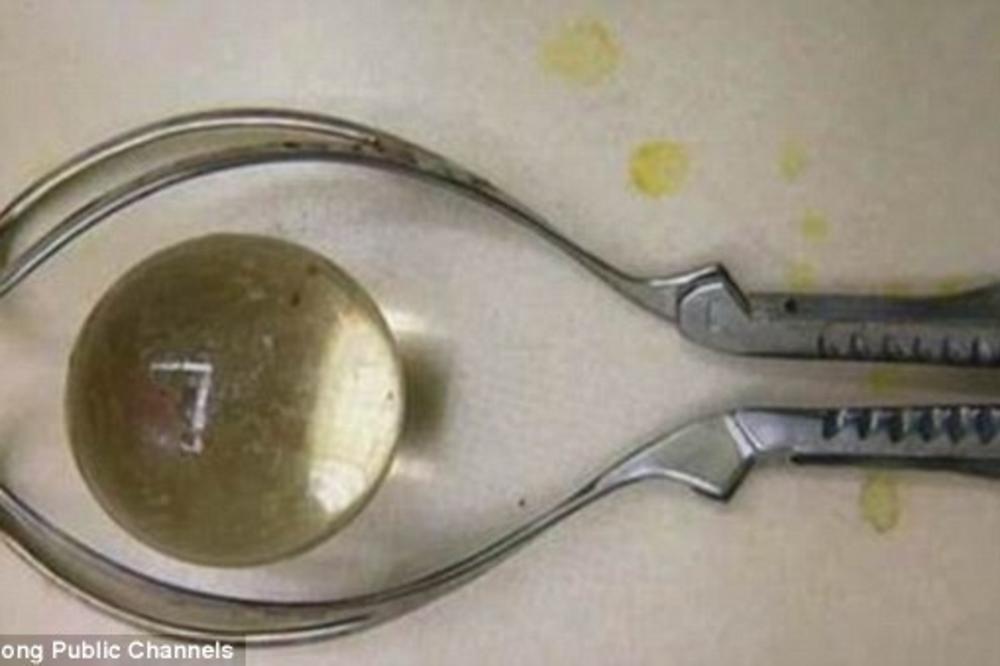 Žalio se da ne može da ide u wc, kad su ga stavili na magnet, doktori su zanemeli od šoka - JEZIVO ŠTA JE STAVIO!