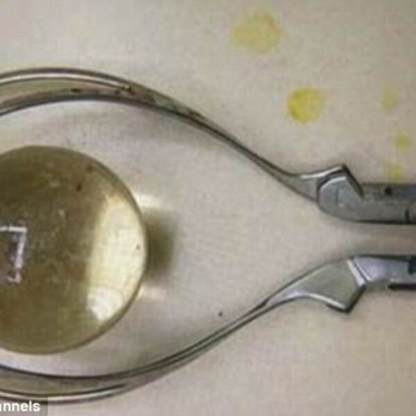 Žalio se da ne može da ide u wc, kad su ga stavili na magnet, doktori su zanemeli od šoka - JEZIVO ŠTA JE STAVIO!