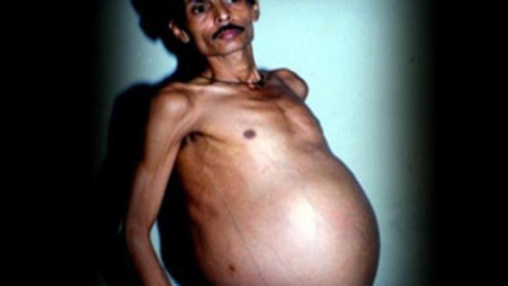 Jezivi slučaj himerizma u Indiji