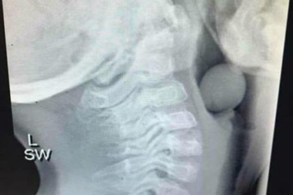 DEČAK HITNO PREVEZEN U BOLNICU, DOKTORI URADILI RENDGEN I DOŽIVELI VELIKI ŠOK: Pogledajte šta je ovo dete PROGUTALO