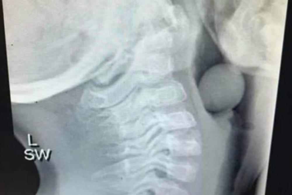 DEČAK HITNO PREVEZEN U BOLNICU, DOKTORI URADILI RENDGEN I DOŽIVELI VELIKI ŠOK: Pogledajte šta je ovo dete PROGUTALO