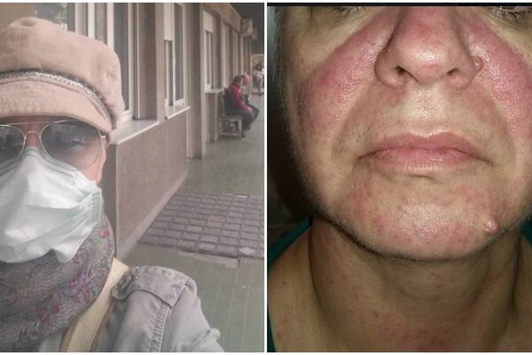 7 DANA PAKLA, LEVITIRANJE IZMEĐU JAVE I KOŠMARA... Žena opisala kako izgleda imati MALE BOGINJE i prozvala sve koji NISU VAKCINISALI DECU!