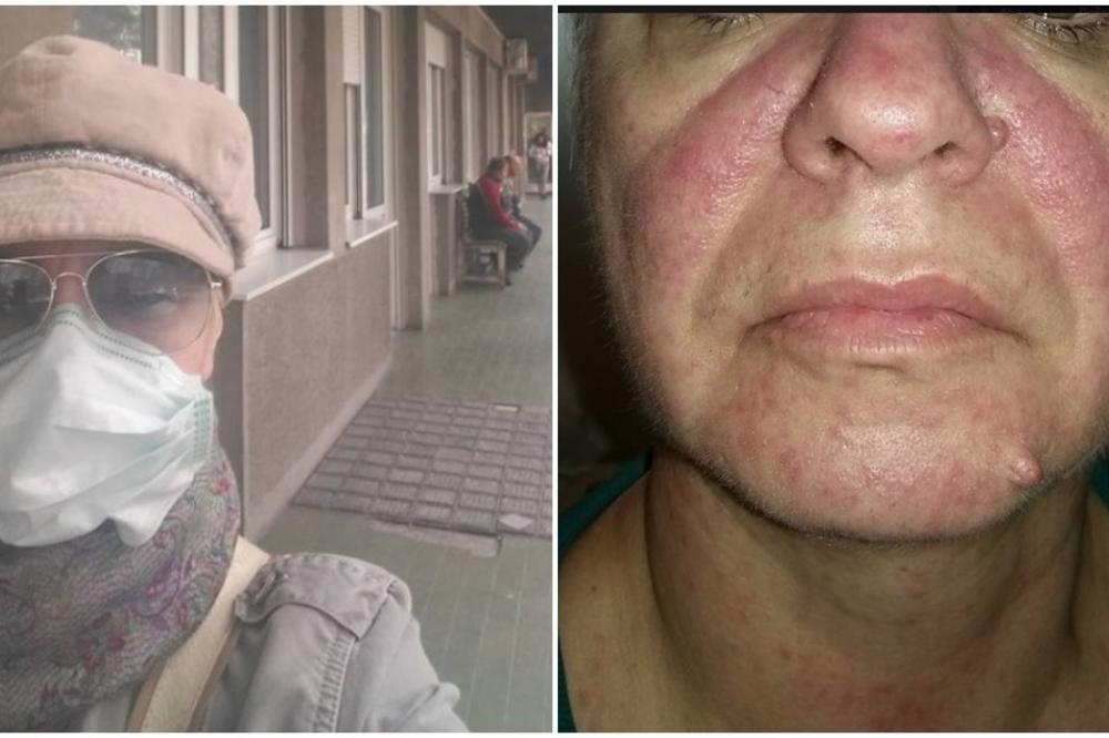 7 DANA PAKLA, LEVITIRANJE IZMEĐU JAVE I KOŠMARA... Žena opisala kako izgleda imati MALE BOGINJE i prozvala sve koji NISU VAKCINISALI DECU!