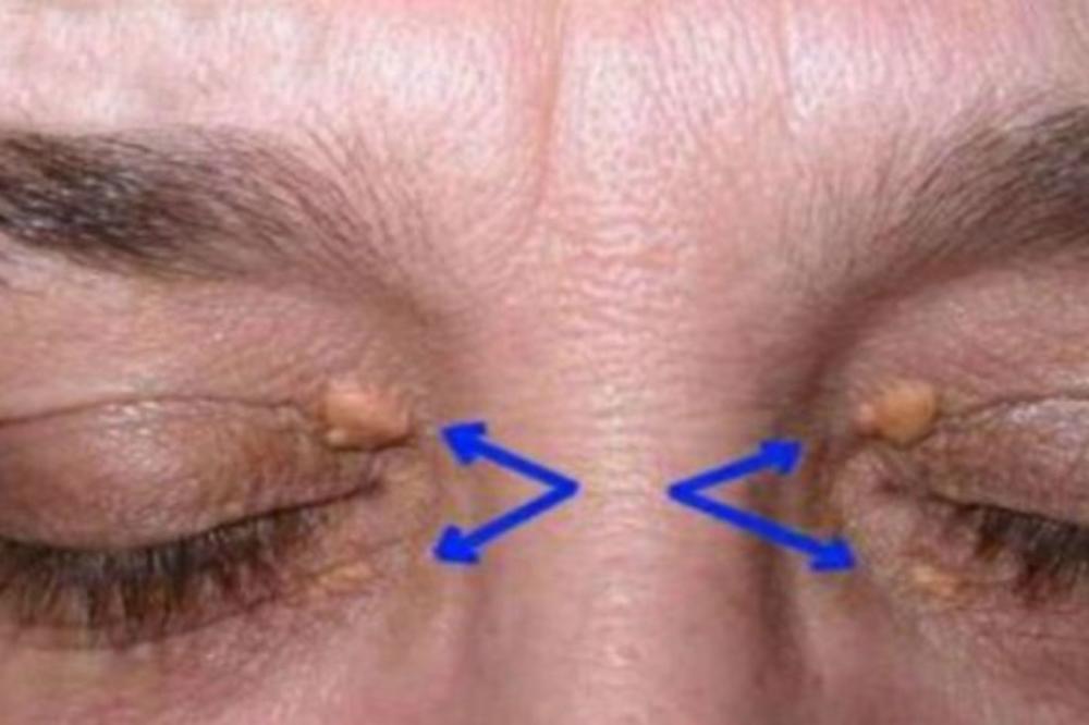 NAPIO SE I "KOMIRAO", A POSLE NIŠTA NIJE VIDEO: Muškarac skoro OSLEPEO spavajući, ovo ćete pročitati DVA PUTA