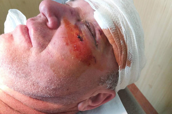 PRETUČEN ČLAN SNS: Naprednjaci tvrde da su to učinili batinaši iz Jeremićeve stranke!