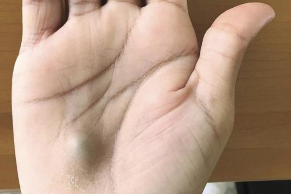 POJAVILA MU SE ČUDNA KVRŽICA NA DLANU: Kada je otišao lekaru, saznao je UŽASNU ISTINU!