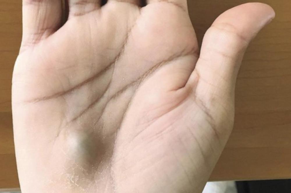 POJAVILA MU SE ČUDNA KVRŽICA NA DLANU: Kada je otišao lekaru, saznao je UŽASNU ISTINU!