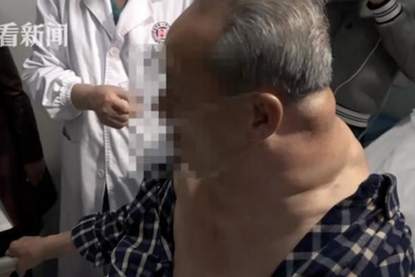 SVAKOGA DANA JE PIO BAR LITAR ALKOHOLA, I TAKO 25 GODINA: Ono što mu se desilo sa telom je ISTINSKI HOROR! (FOTO)