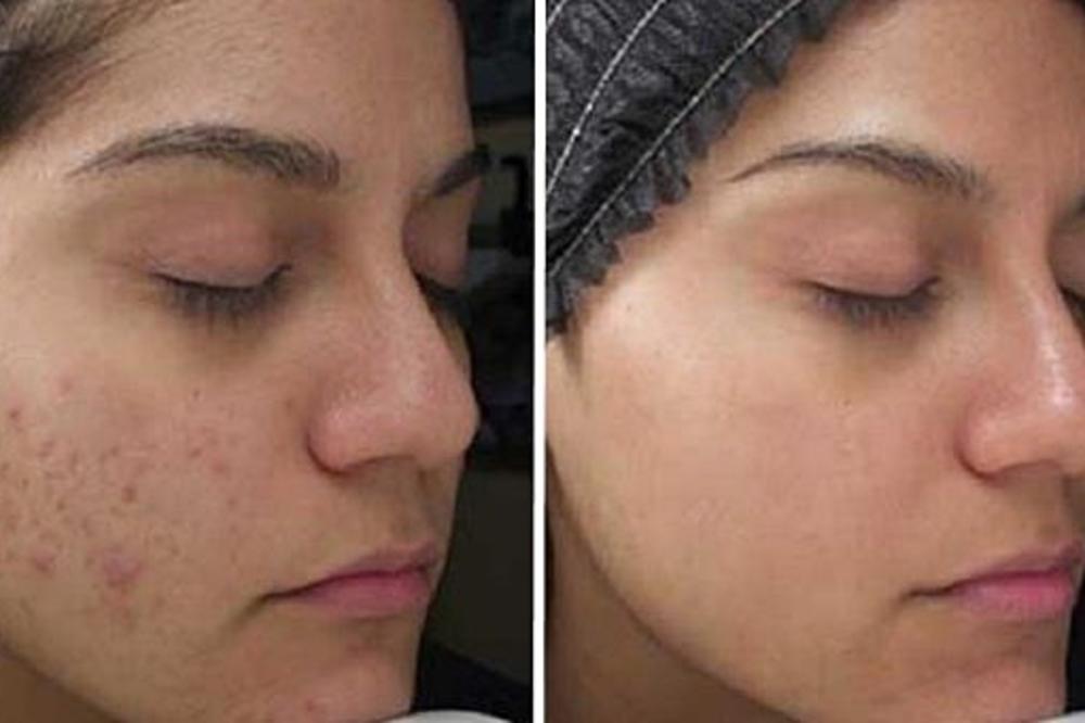 NAPRAVITE OVU MASU KOD KUĆE, PA NANESITE NA OŽILJAK! Nestaje kao da ga nikada nije ni bilo!