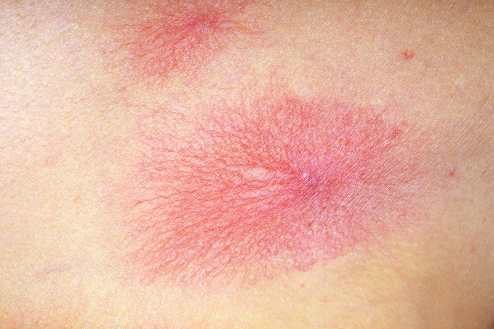 AKO PRIMETITE CRVENE TAČKE NA TELU NI SLUČAJNO IH NE SMETE IGNORISATI: Postoje 2 RAZLOGA zbog kojih se pojavljuju