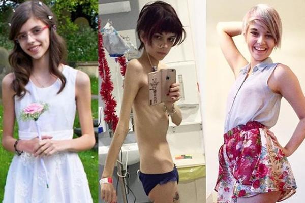 MISLILA SAM DA ĆU UMRETI: Ispovest devojke (20) koja je POBEDILA ANOREKSIJU (FOTO)