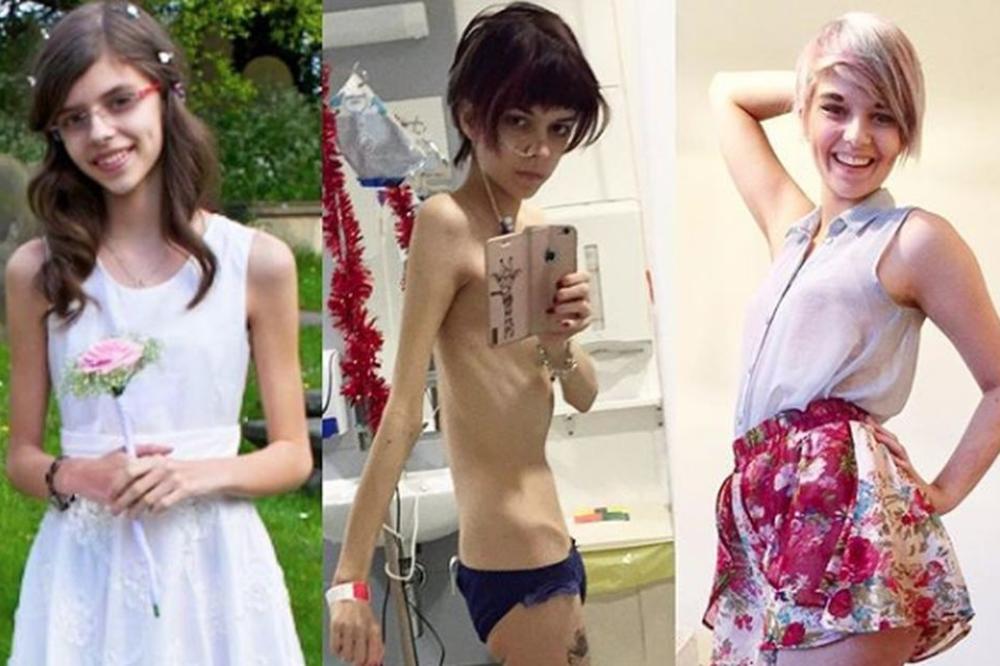 MISLILA SAM DA ĆU UMRETI: Ispovest devojke (20) koja je POBEDILA ANOREKSIJU (FOTO)