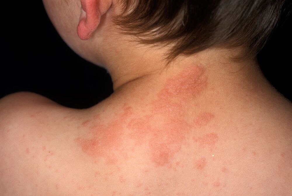 Alergije su takođe vrlo čest uzrok svraba kože  