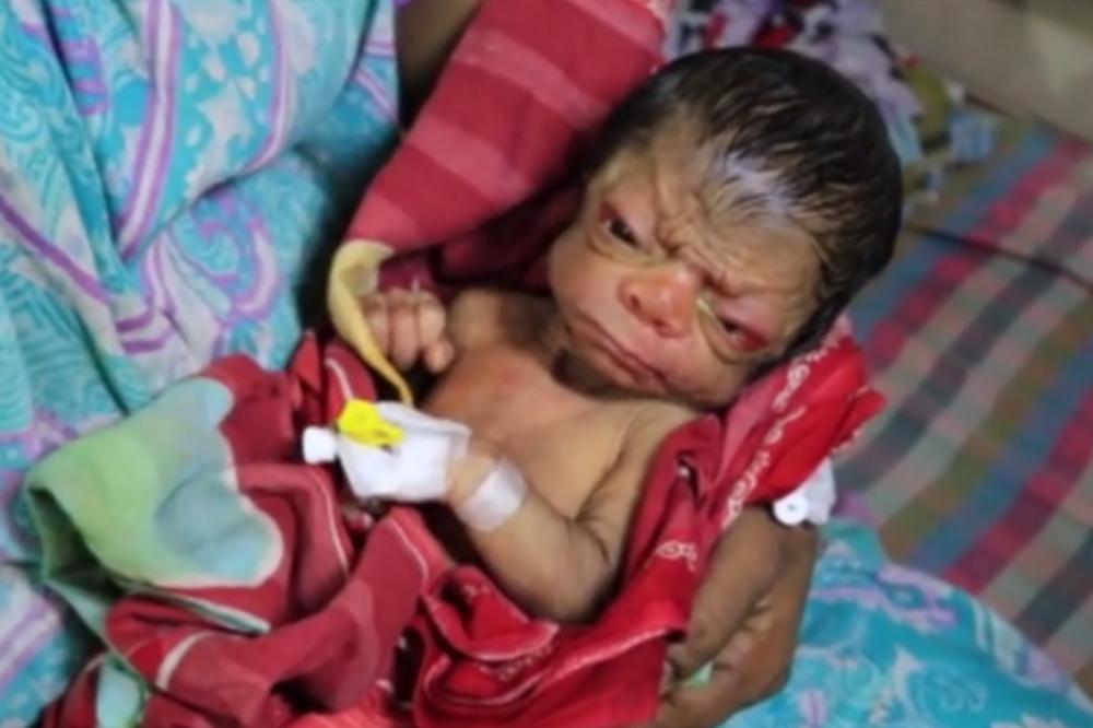 BORE I LICE STARCA: Zbog retke bolesti beba izgleda kao 80 - godišnjak u telu deteta! (Video)