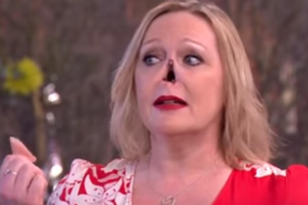 ZBOG RETKE BOLESTI MORALI SU DA JOJ AMPUTIRAJU NOS! Sada je dobila novi koji stoji pomoću MAGNETA! (VIDEO)