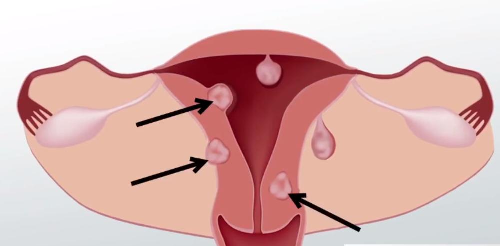 Ožiljci na materici  mogu uticati na kraće trajanje menstruacije  