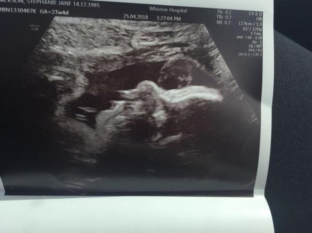 Stefani tvrdi da je na snimku sa ultrazvuka videla lik svoje pokojne bake  