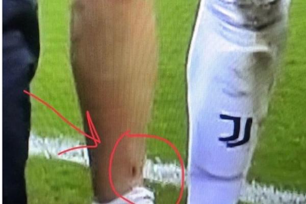 KRVAV JE TO LEBAC! Mario Mandžukić protiv Intera igrao sa RUPOM U NOZI! (VIDEO)