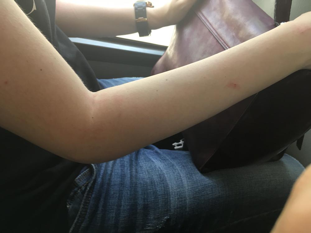 Pri povratku sa terena njene ruke su bile pune uboda od komaraca i drugih insekata  