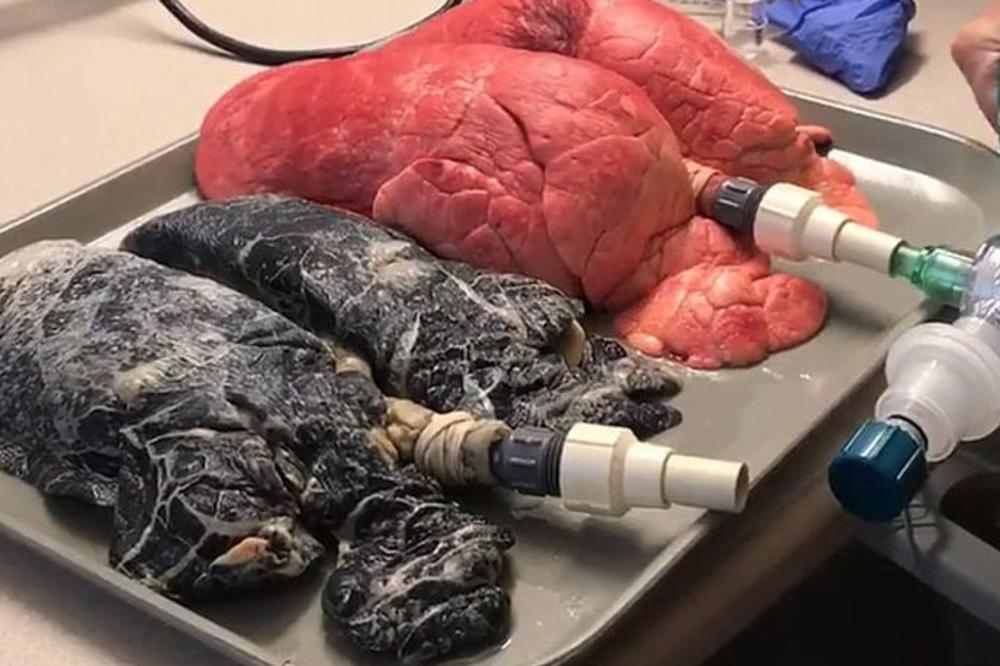 POSLE OVOG SNIMKA ĆETE KONAČNO PRESTATI DA PUŠITE: Medicinska sestra je naduvala pluća pušača, A ONDA.. (VIDEO)