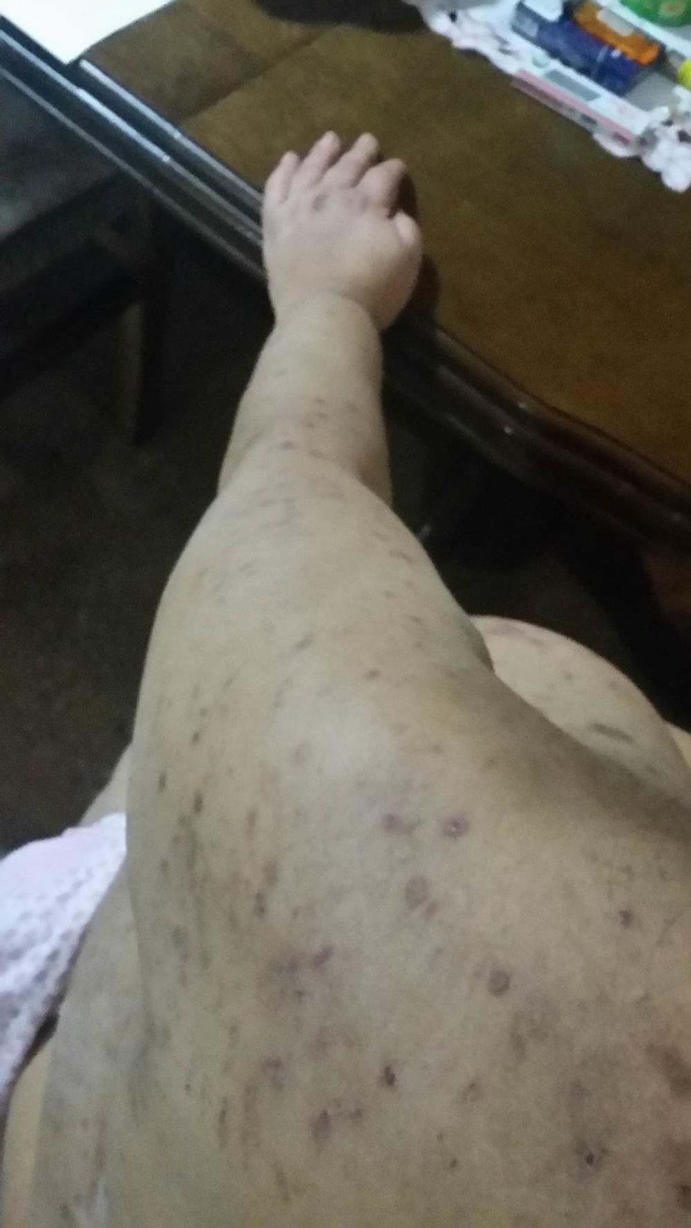 Zorica Azirović je pretrpela PAKAO zbog greške lekara