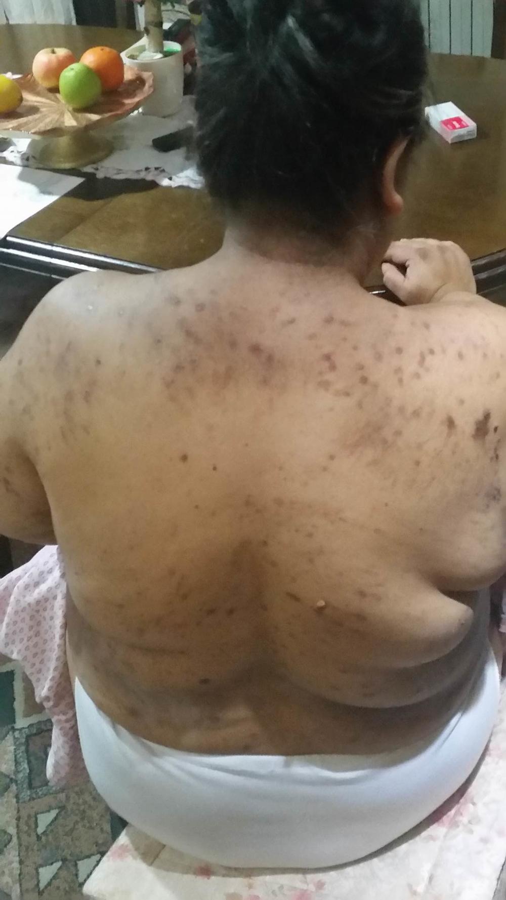 Zorica Azirović je pretrpela PAKAO zbog greške lekara