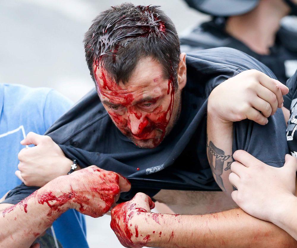 Jedan od povređenih učesnika tuče Delija i Grobara