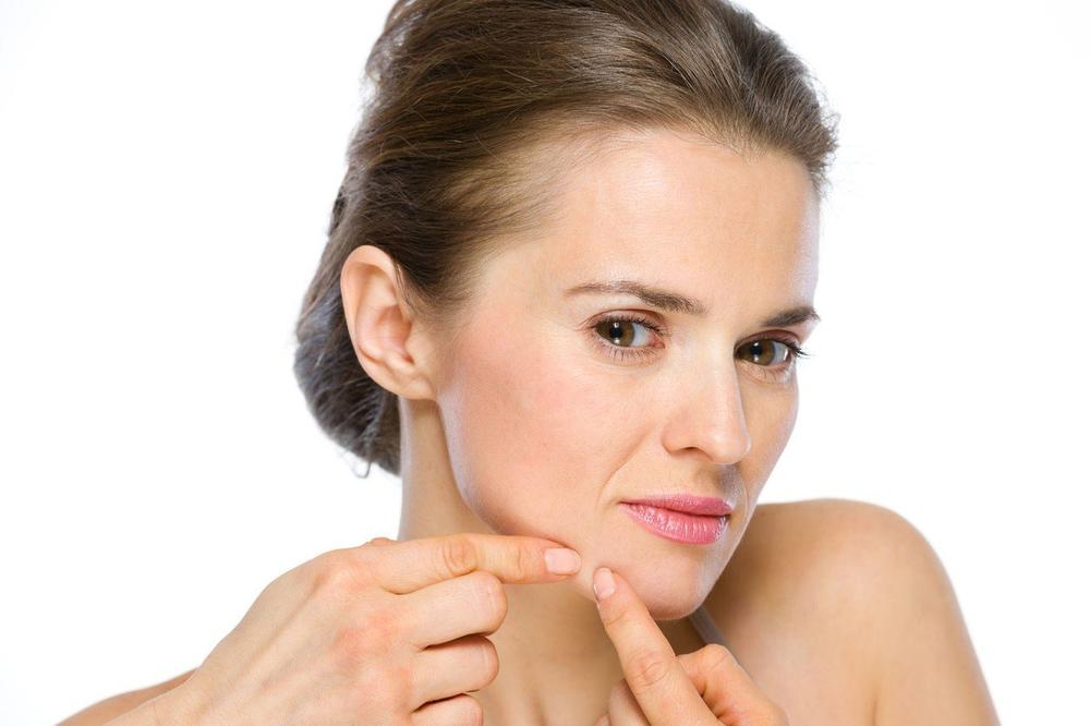 IMATE PROBLEMA SA AKNAMA? Možda je za to krivo MLEKO! Stručnjaci imaju reč