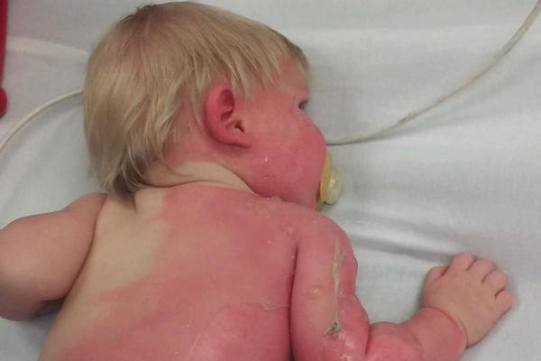 BEBA JE ZADOBILA OPASNE OPEKOTINE I TO KRIVICOM MAJKE: Roditelji, niste ni svesni opasnosti koja vreba, OBRATITE PAŽNJU (FOTO)