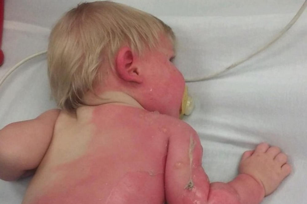 BEBA JE ZADOBILA OPASNE OPEKOTINE I TO KRIVICOM MAJKE: Roditelji, niste ni svesni opasnosti koja vreba, OBRATITE PAŽNJU (FOTO)
