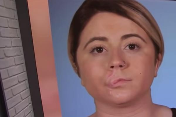 U NAPADU PSA IZGUBILA JE DEO LICA: Hirurzi su uspeli da joj potpuno TRANSFORMIŠU užasan ožiljak! (VIDEO)