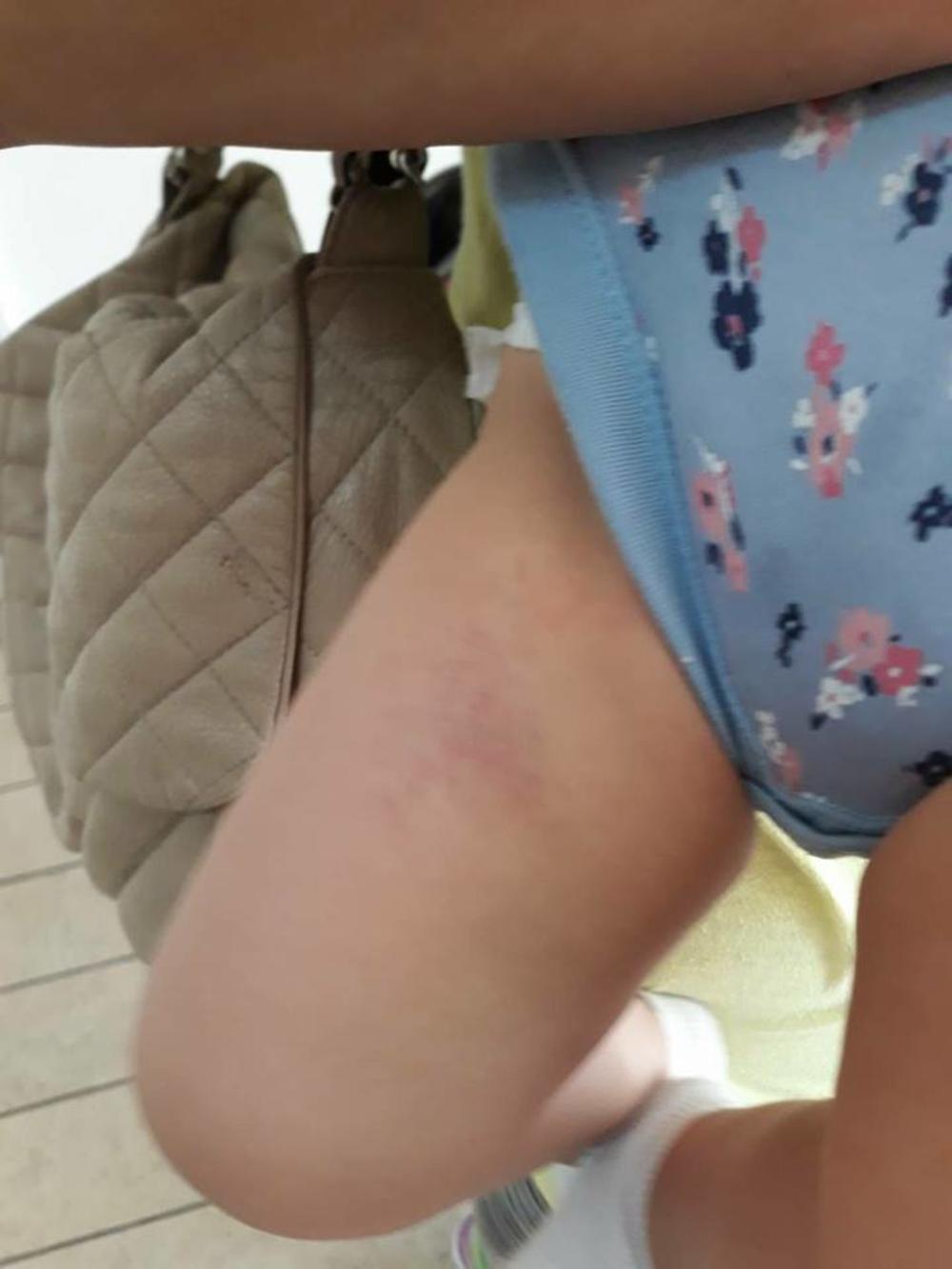 Dete ima modrice po nogama  