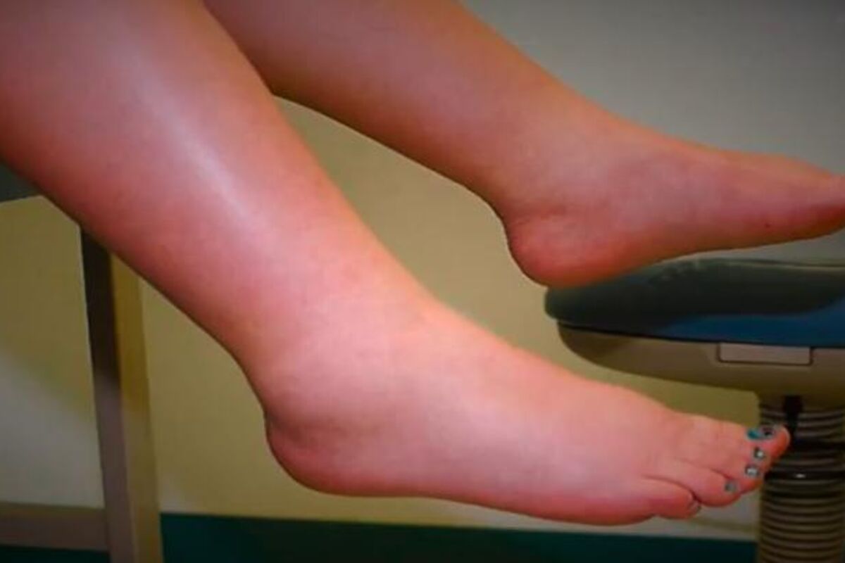 Uobičajeni uzroci oticanja noge ili preopterećenja tekućine