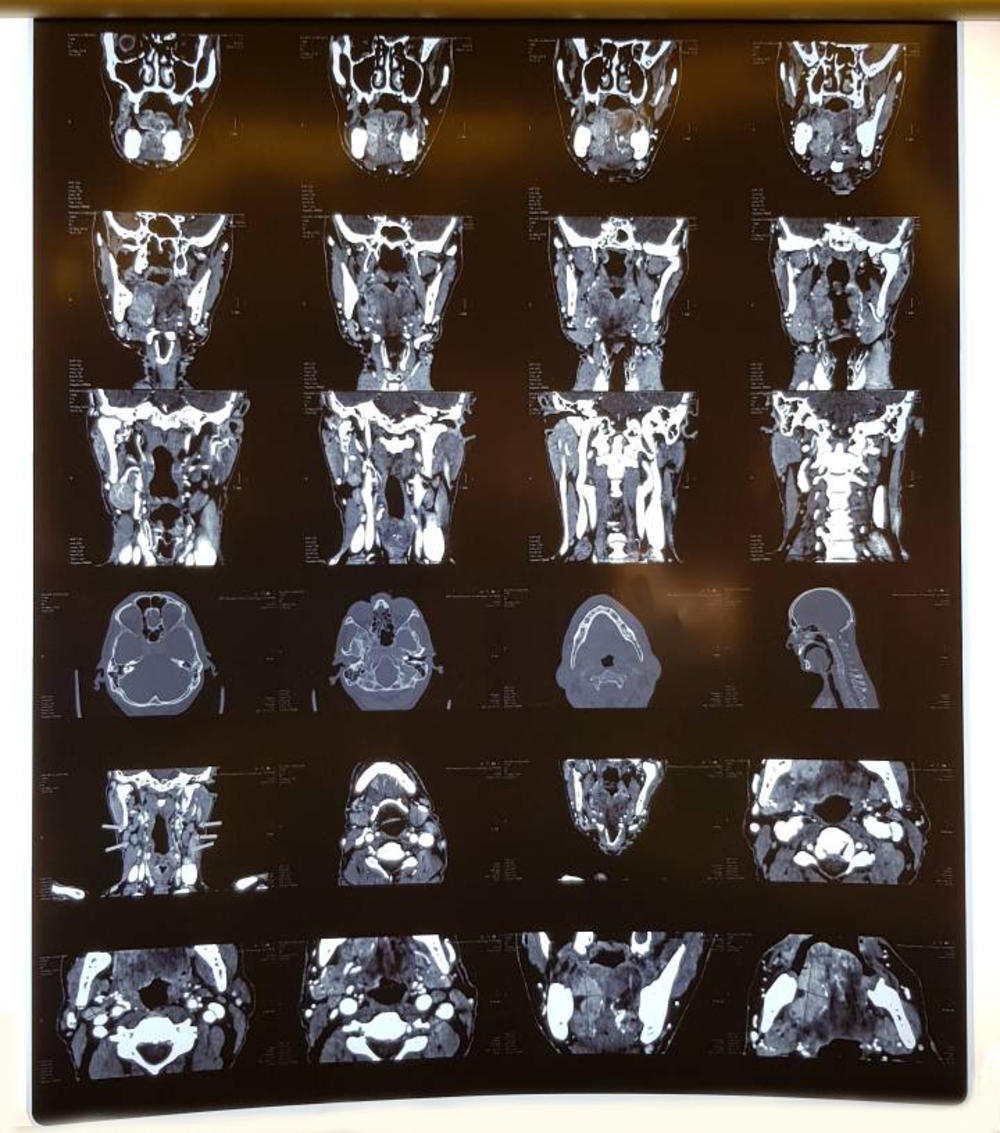 Nov jezik od natkolenice  