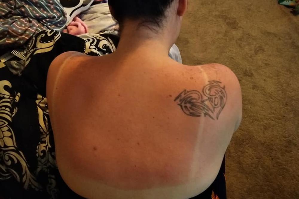 OVA ŽENA JE OTKRILA BRZO REŠENJE ZA OPEKOTINE: Potreban je samo JEDAN SASTOJAK i NESTAĆE za 30 minuta (FOTO)