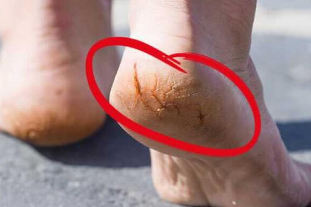 Otkrila tajni recept: Evo kako da uklonite zadebljalu kožu sa peta koristeći samo ova dva sastojka!