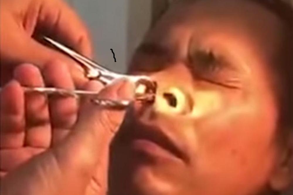 NEŠTO MU SE MRDALO U NOZDRVAMA, a kad mu je lekar izvadio OVO iz nosa, medicinska sestra je PALA U NESVEST (VIDEO)
