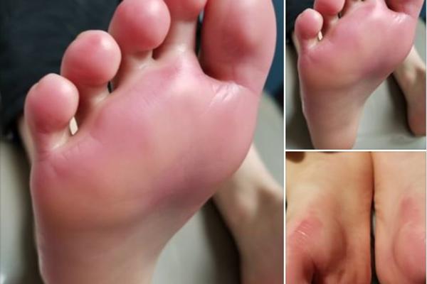 DEČAK (9) DOBIO OPEKOTINE DRUGOG STEPENA ZBOG SVETLEĆIH PATIKA! Baterije otpuštaju hemikalije koje DECI prave PAKAO, a UPOZORENJA NEMA?! (FOTO)