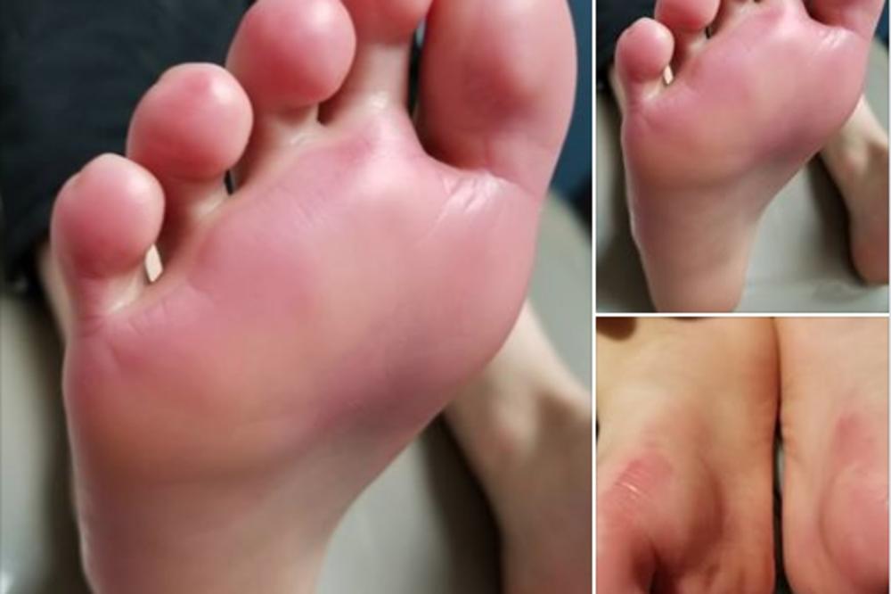 DEČAK (9) DOBIO OPEKOTINE DRUGOG STEPENA ZBOG SVETLEĆIH PATIKA! Baterije otpuštaju hemikalije koje DECI prave PAKAO, a UPOZORENJA NEMA?! (FOTO)