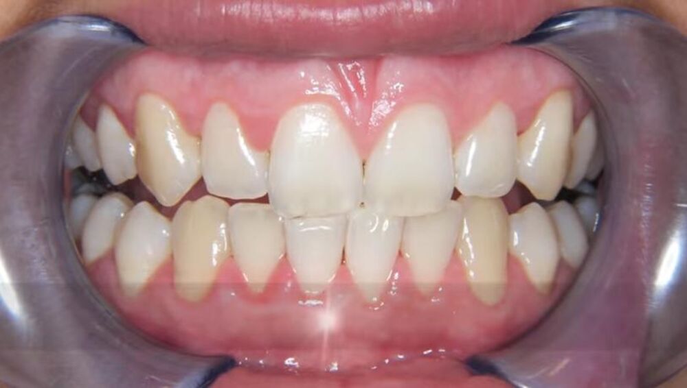 Uklonite karijes kod kuće uz pomoć kokosovog ulja  