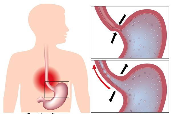 KAKO UBLAŽITI GORUŠICU PRIRODNIM PUTEM? 3 načina da je POTPUNO SMIRITE, ostaćete u šoku kako ovo NISTE ZNALI RANIJE