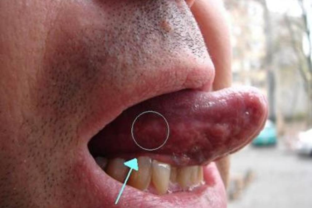 KAD OTVORITE USTA POGLEDAJTE SE U OGLEDALO: Ako imate OVO, HITNO KOD LEKARA, ne ignorišite! (FOTO)