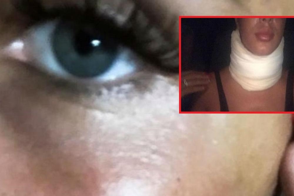 ISPLIVAO SNIMAK PREBIJANJA ALEKSANDRE SUBOTIĆ: Sva u modricama i ogrebotinama sa KRAGNOM oko vrata! Čabarkapa tvrdi da je ona njega udarila?