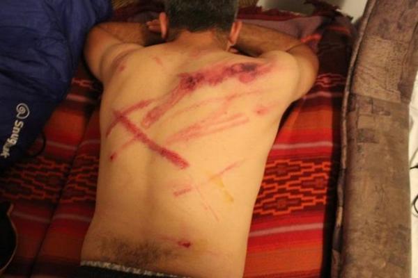 ŠOKANTNE FOTOGRAFIJE MIGRANTA: Ovako mu izgledaju leđa nakon susreta sa policijom!