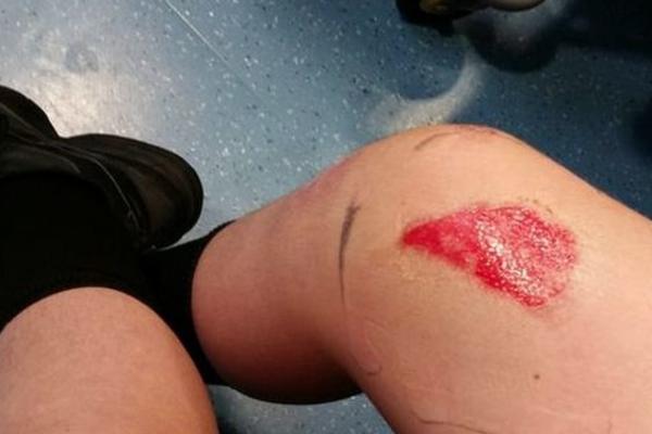 Dečaku iz poznatog lanca brze hrane pao SOS NA NOGU, u sledećem momentu je koža počela da mu OTPADA (FOTO)