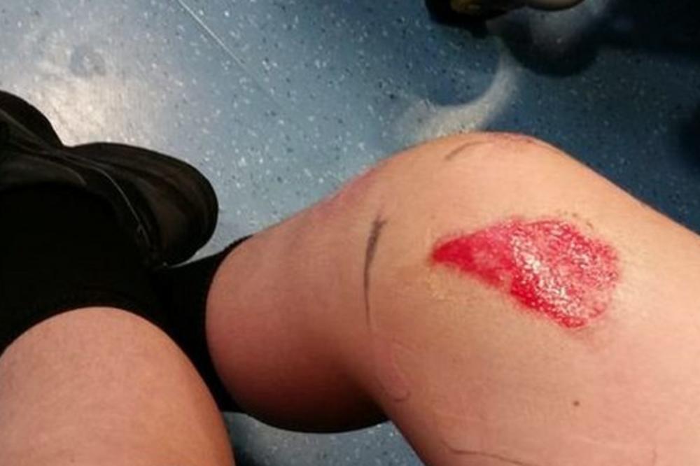 Dečaku iz poznatog lanca brze hrane pao SOS NA NOGU, u sledećem momentu je koža počela da mu OTPADA (FOTO)