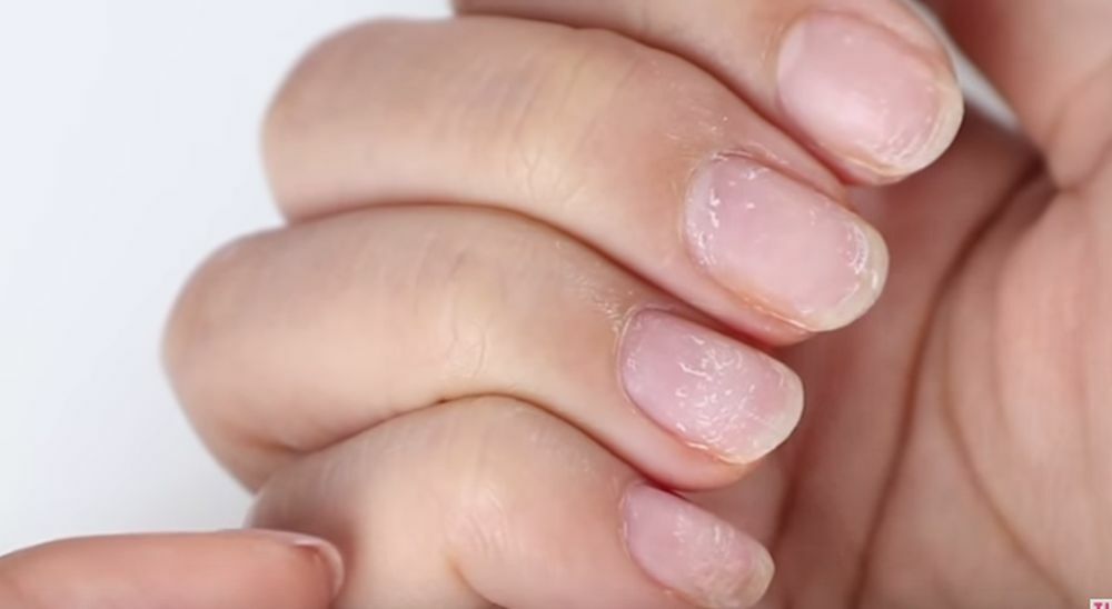 Nokti koji se listaju mogu ukazivati na bolesti štitne žlezde  