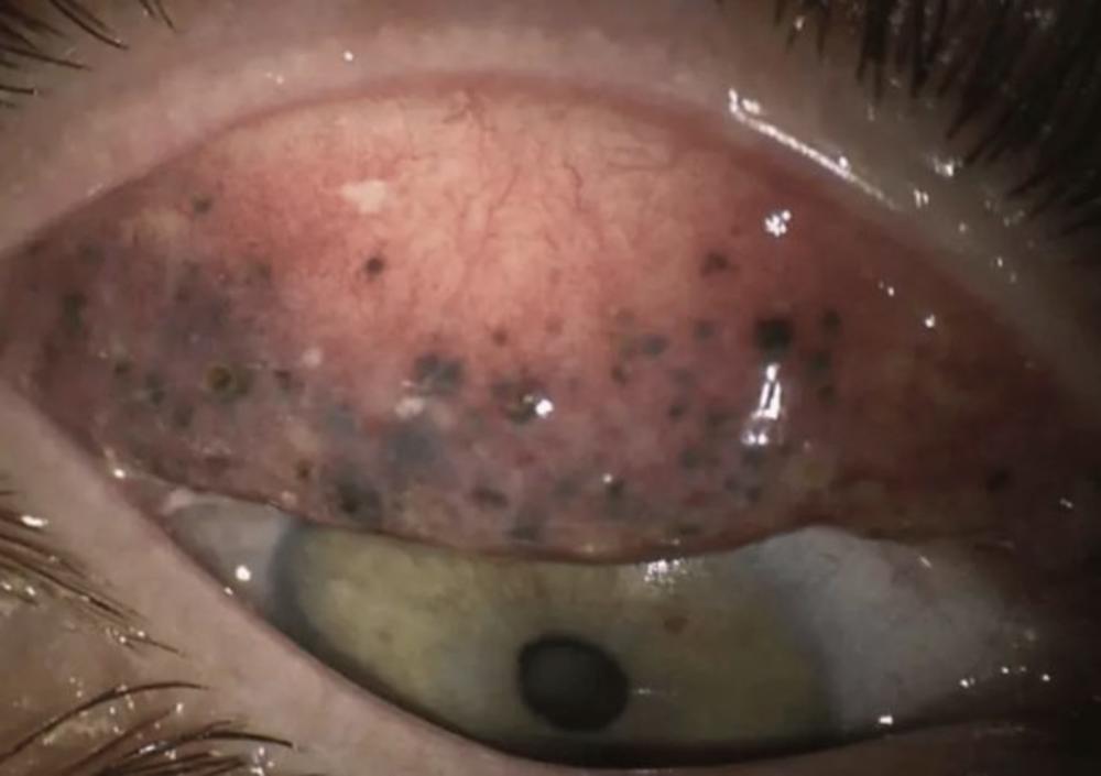 Grumuljice po kapcima