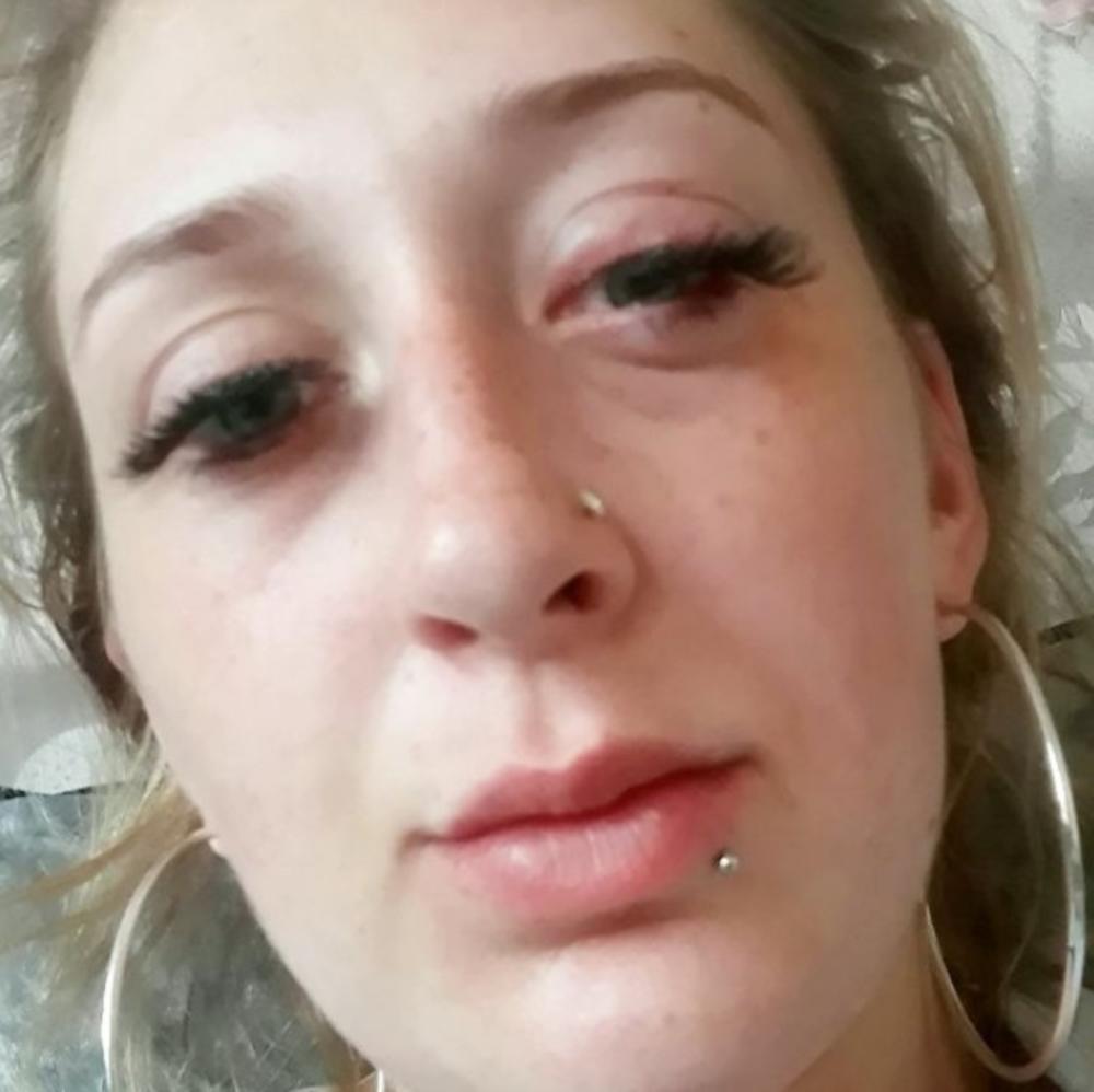 Oslepela je na dva dana od lepka za trepavice  