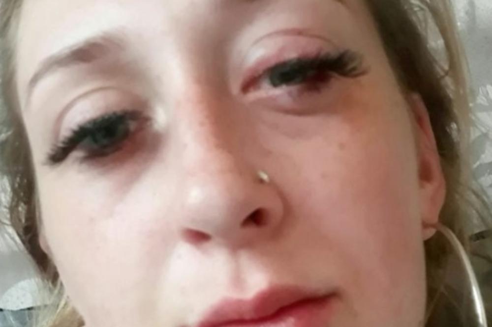 TRUDNICA IZGUBILA VID NA 2 DANA ZBOG KOZMETIČKOG TRETMANA, PA OPISALA MUKE KOJE JE DOŽIVELA: Žene ga koriste svakodnevno, a nisu ni svesne koliko je opasan! (FOTO)